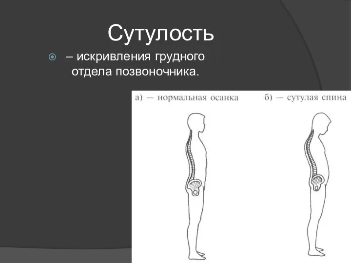 Сутулость – искривления грудного отдела позвоночника.