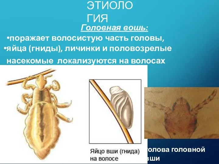 Головная вошь: поражает волосистую часть головы, яйца (гниды), личинки и половозрелые насекомые