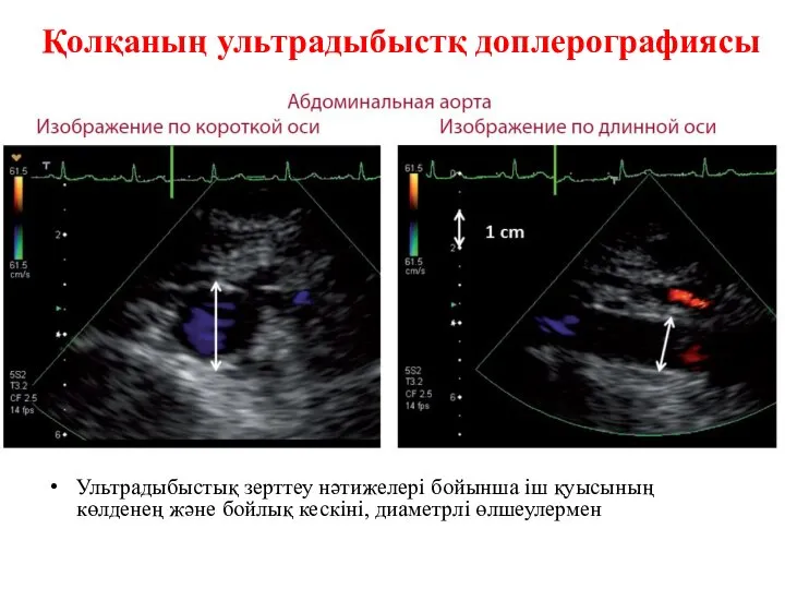 Ультрадыбыстық зерттеу нәтижелері бойынша іш қуысының көлденең және бойлық кескіні, диаметрлі өлшеулермен Қолқаның ультрадыбыстқ доплерографиясы