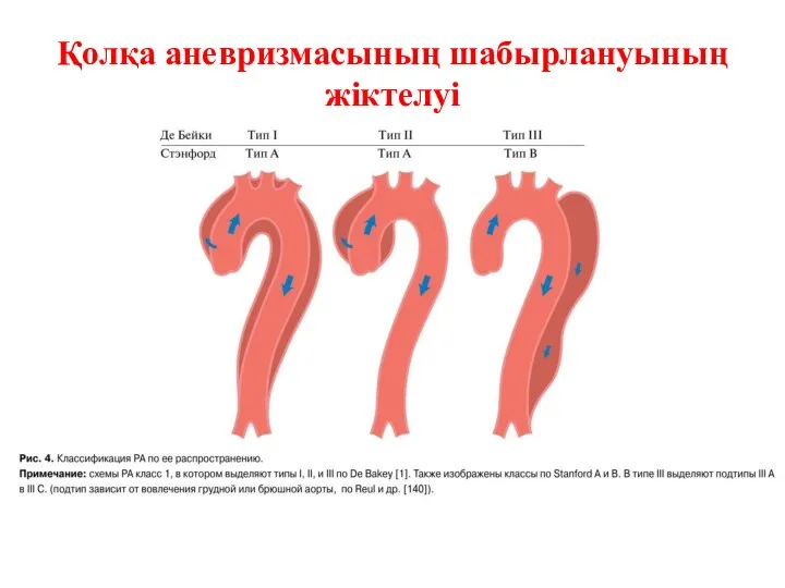 Қолқа аневризмасының шабырлануының жіктелуі