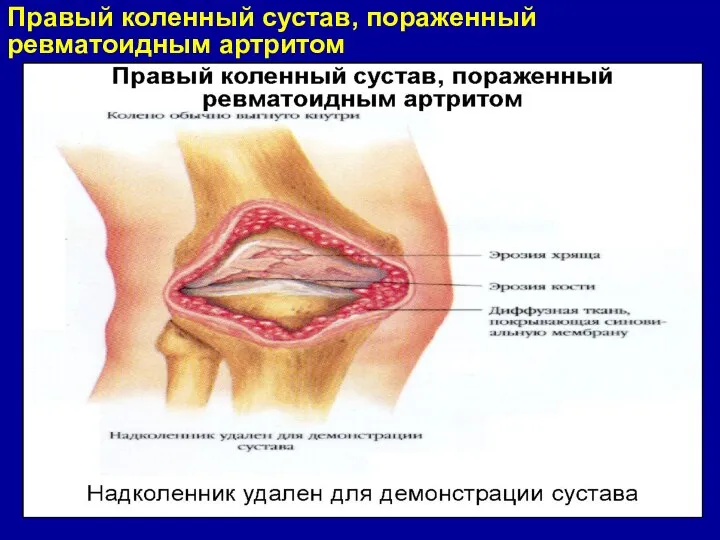 Правый коленный сустав, пораженный ревматоидным артритом