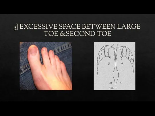 5} EXCESSIVE SPACE BETWEEN LARGE TOE &SECOND TOE