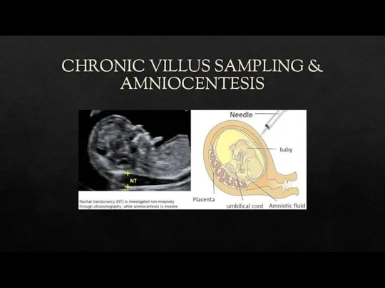 CHRONIC VILLUS SAMPLING & AMNIOCENTESIS