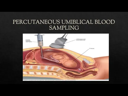 PERCUTANEOUS UMIBLICAL BLOOD SAMPLING