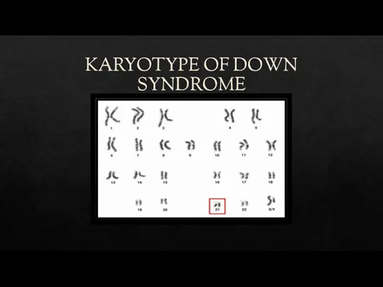 KARYOTYPE OF DOWN SYNDROME