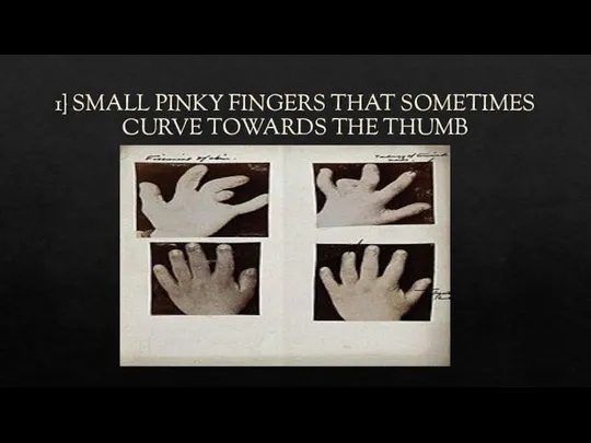 1} SMALL PINKY FINGERS THAT SOMETIMES CURVE TOWARDS THE THUMB