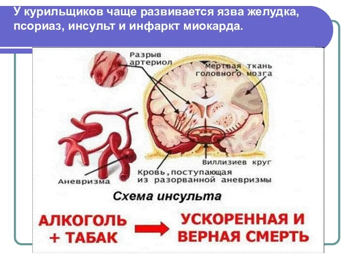 У курильщиков чаще развивается язва желудка, псориаз, инсульт и инфаркт миокарда.