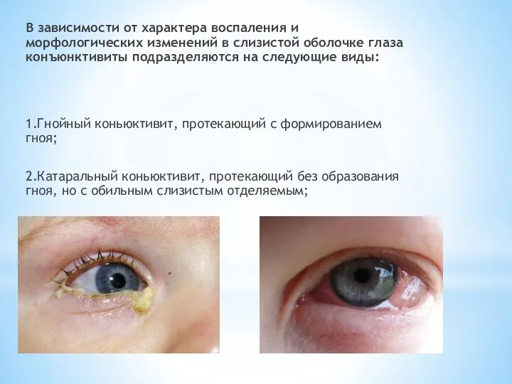 В зависимости от характера воспаления и морфологических изменений в слизистой оболочке глаза
