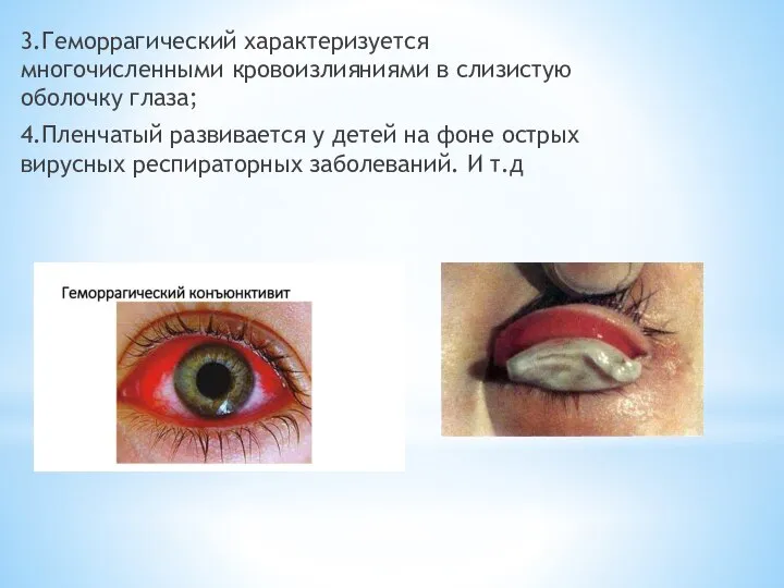 3.Геморрагический характеризуется многочисленными кровоизлияниями в слизистую оболочку глаза; 4.Пленчатый развивается у детей