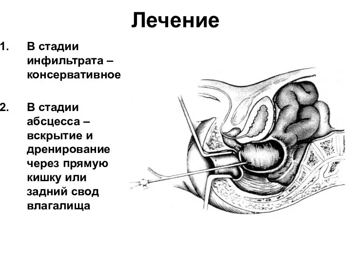 Лечение В стадии инфильтрата – консервативное В стадии абсцесса – вскрытие и