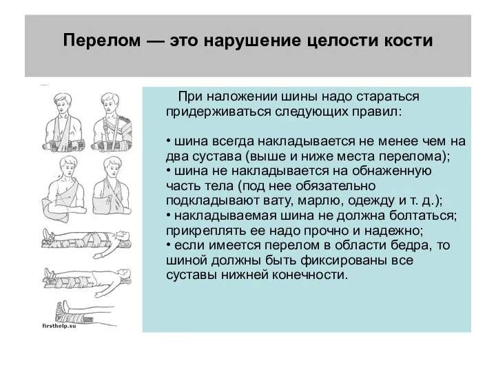 Перелом — это нарушение целости кости При наложении шины надо стараться придерживаться