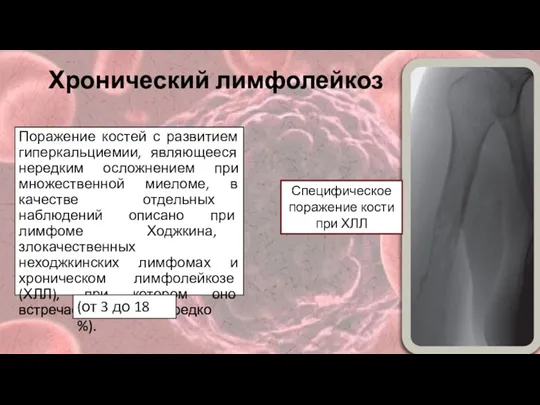 Хронический лимфолейкоз Поражение костей с развитием гиперкальциемии, являющееся нередким осложнением при множественной