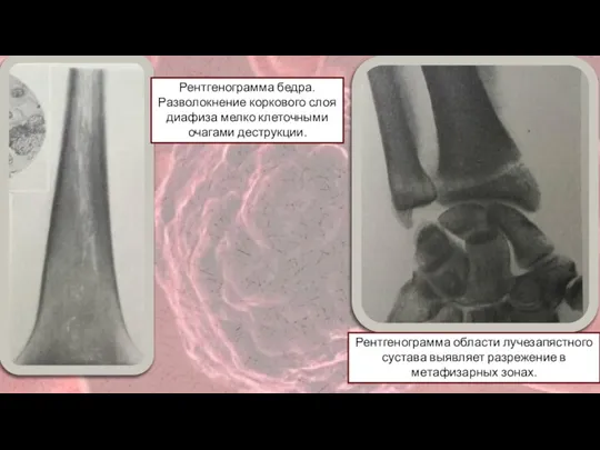 Рентгенограмма бедра. Разволокнение коркового слоя диафиза мелко клеточными очагами деструкции. Рентгенограмма области