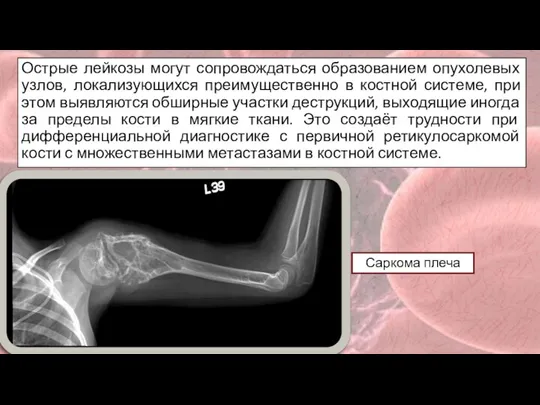 Острые лейкозы могут сопровождаться образованием опухолевых узлов, локализующихся преимущественно в костной системе,