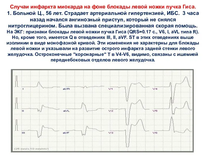 Случаи инфаркта миокарда на фоне блокады левой ножки пучка Гиса. 1. Больной