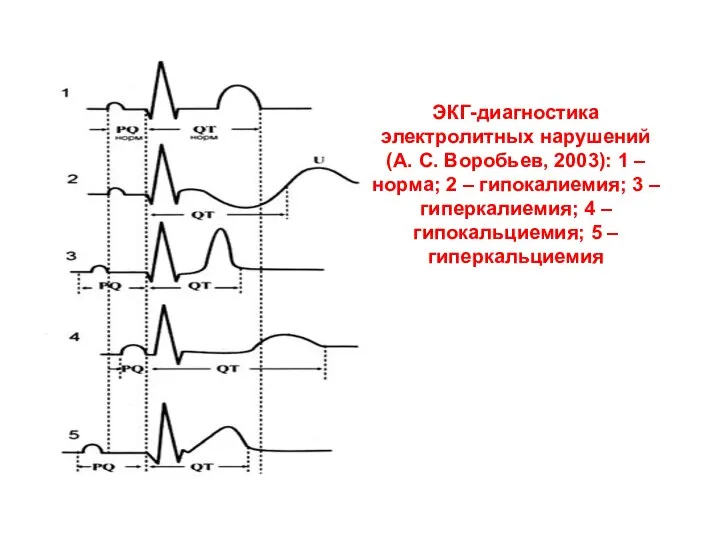 ЭКГ-диагностика электролитных нарушений (А. С. Воробьев, 2003): 1 – норма; 2 –