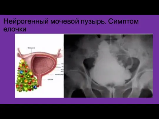 Нейрогенный мочевой пузырь. Симптом елочки