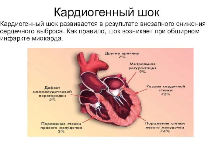 Кардиогенный шок Кардиогенный шок развивается в результате внезапного снижения сердечного выброса. Как