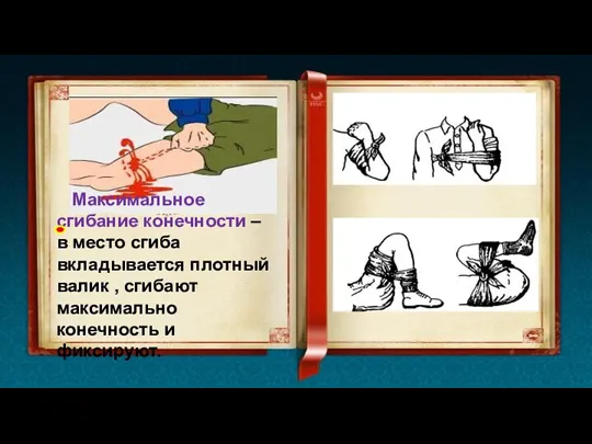 Максимальное сгибание конечности – в место сгиба вкладывается плотный валик , сгибают максимально конечность и фиксируют.