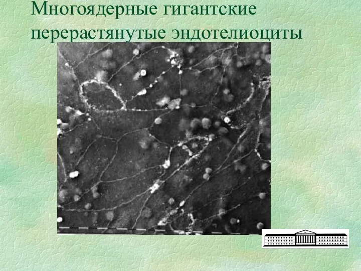 Многоядерные гигантские перерастянутые эндотелиоциты