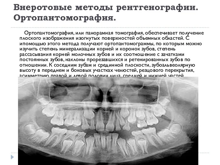 Внеротовые методы рентгенографии. Ортопантомография. Ортопантомография, или панорамная томография, обеспечивает получение плоского изображения