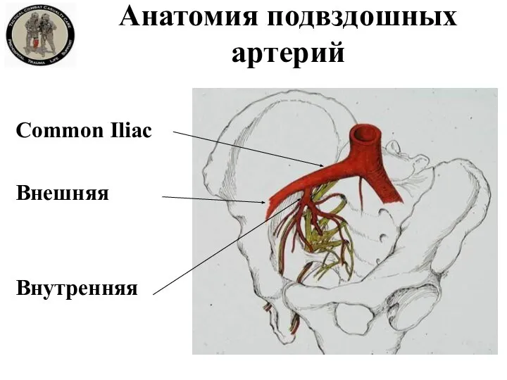 Анатомия подвздошных артерий Common Iliac Внешняя Внутренняя