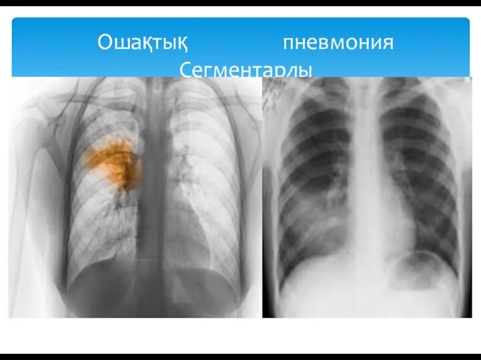 Ошақтық пневмония Сегментарлы