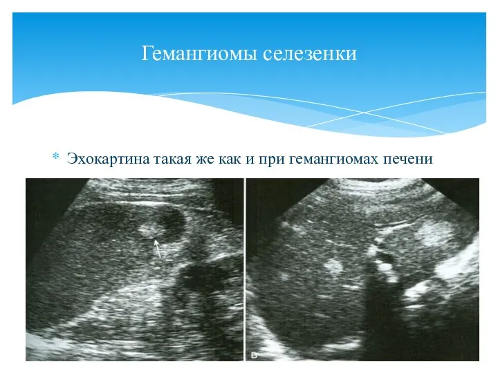 Эхокартина такая же как и при гемангиомах печени Гемангиомы селезенки