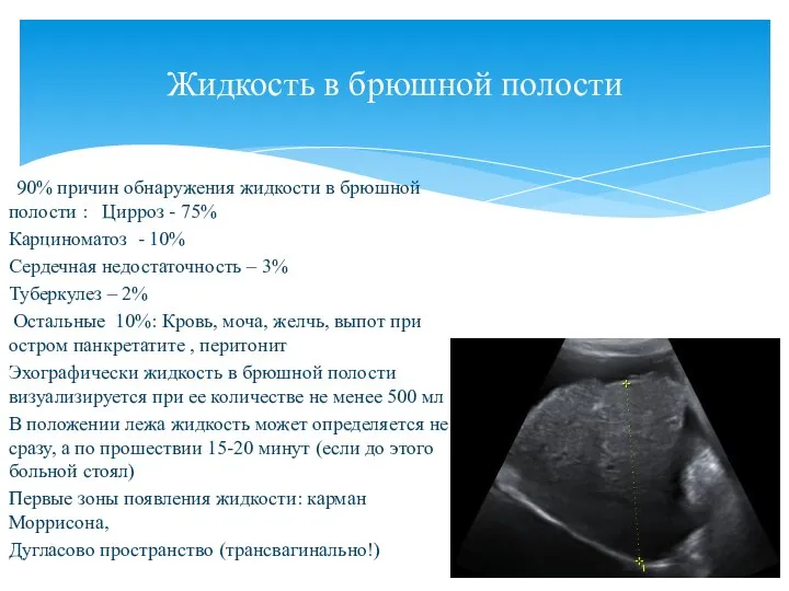 90% причин обнаружения жидкости в брюшной полости : Цирроз - 75% Карциноматоз