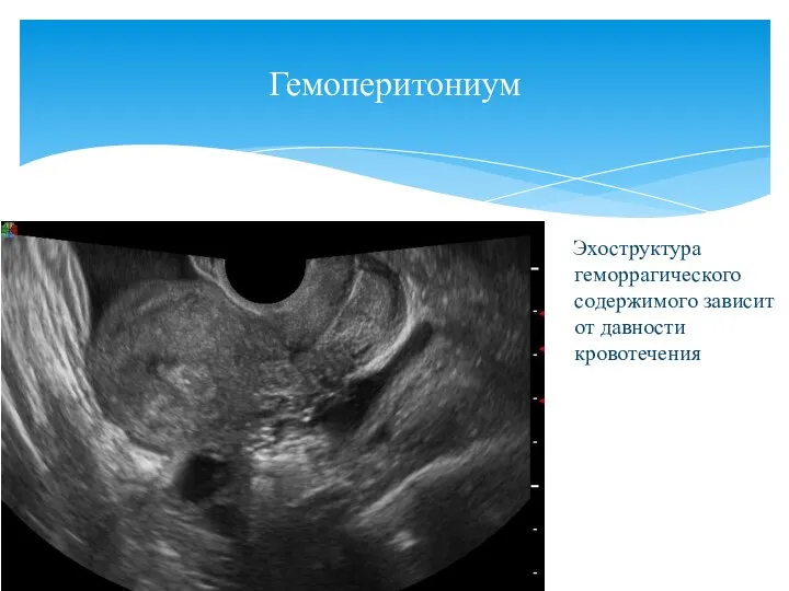 Гемоперитониум Эхоструктура геморрагического содержимого зависит от давности кровотечения