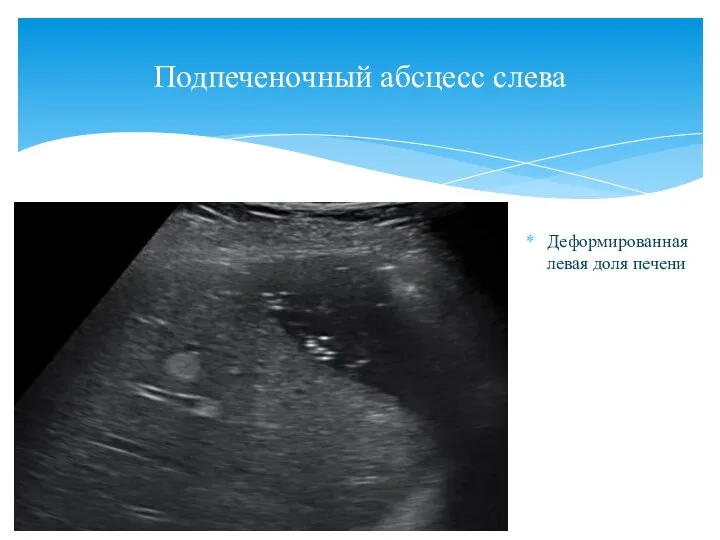 Деформированная левая доля печени Подпеченочный абсцесс слева