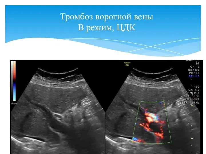 Тромбоз воротной вены В режим, ЦДК