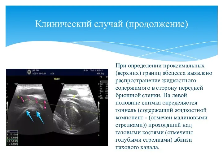 Клинический случай (продолжение) При определении проксимальных(верхних) границ абсцесса выявлено распространение жидкостного содержимого