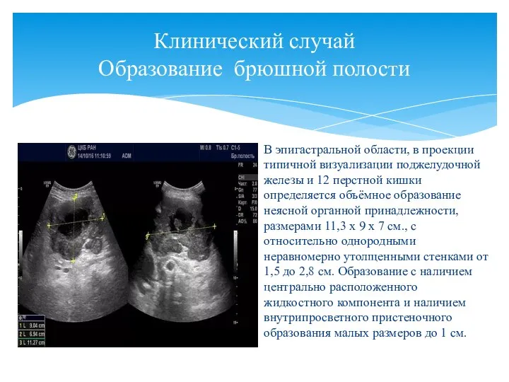 Клинический случай Образование брюшной полости В эпигастральной области, в проекции типичной визуализации