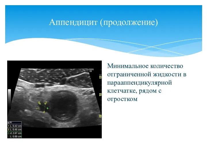 Аппендицит (продолжение) Минимальное количество отграниченной жидкости в парааппендикулярной клетчатке, рядом с отростком