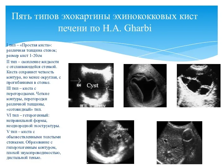 I тип – «Простая киста»: различная толщина стенок; размер кист 1-20см II