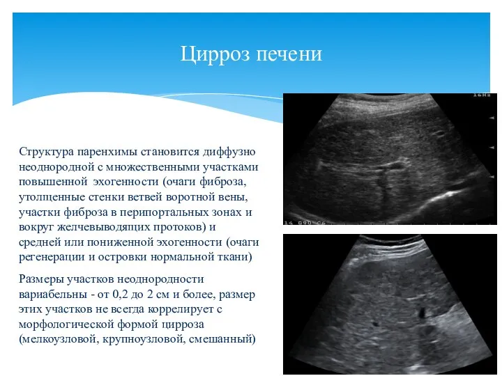 Цирроз печени Структура паренхимы становится диффузно неоднородной с множественными участками повышенной эхогенности