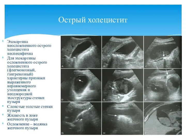Эхокартина неосложненного острого холецистита неспецифична Для эхокартины осложненного острого холецистита (флегмонозный, гангренозный)