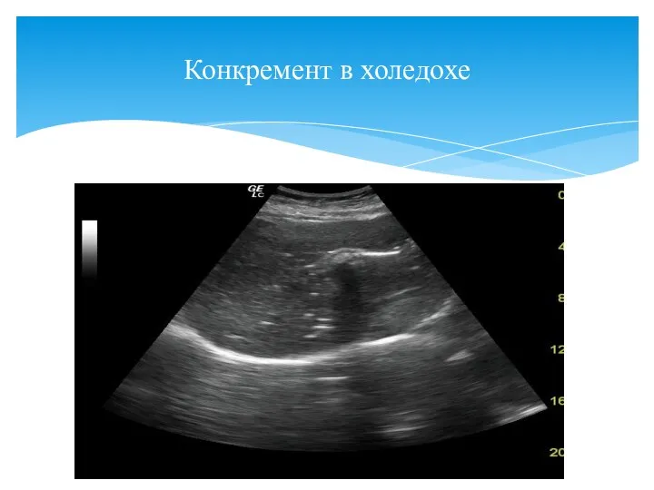 Конкремент в холедохе