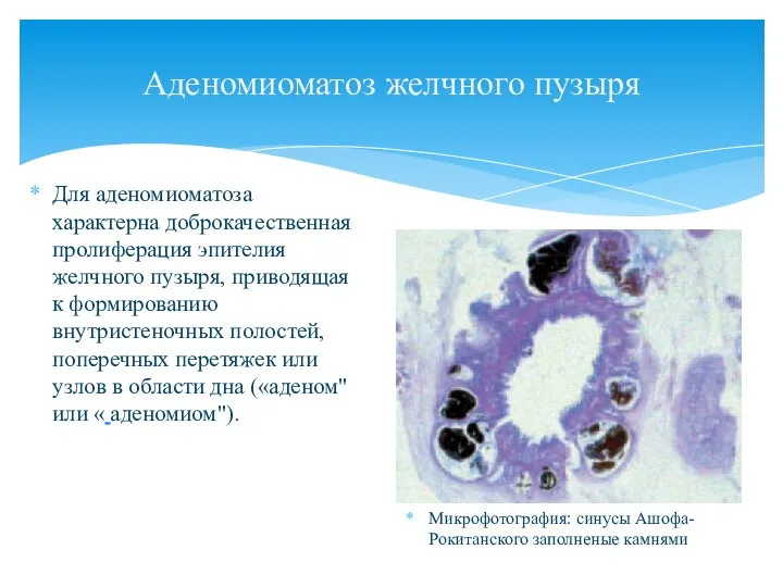Аденомиоматоз желчного пузыря Для аденомиоматоза характерна доброкачественная пролиферация эпителия желчного пузыря, приводящая