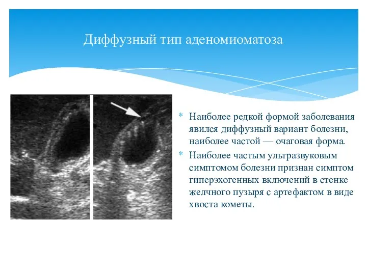 Диффузный тип аденомиоматоза Наиболее редкой формой заболевания явился диффузный вариант болезни, наиболее