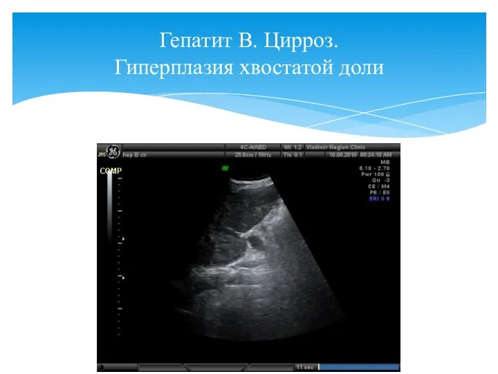 Гепатит В. Цирроз. Гиперплазия хвостатой доли