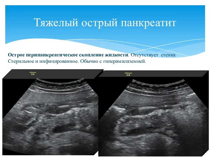 Тяжелый острый панкреатит Острое перипанкреатическое скопление жидкости. Отсутствует стенка. Стерильное и инфицированное. Обычно с гиперамилаземией.