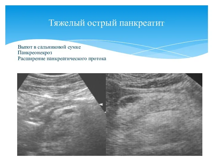 Тяжелый острый панкреатит Выпот в сальниковой сумке Панкреонекроз Расширение панкреатического протока