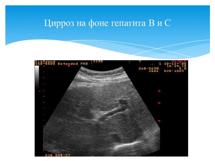 Цирроз на фоне гепатита В и С