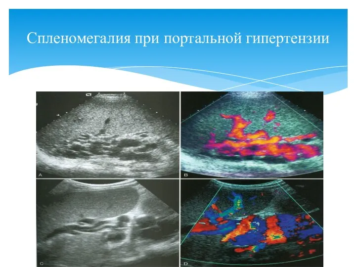 Спленомегалия при портальной гипертензии