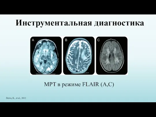 Инструментальная диагностика МРТ в режиме FLAIR (А,С) Deiva, K., et al., 2012