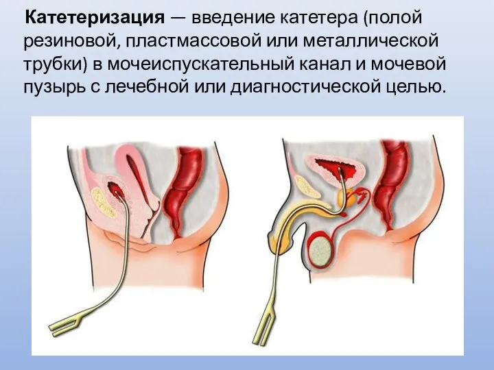 Катетеризация — введение катетера (полой резиновой, пластмассовой или металлической трубки) в мочеиспускательный