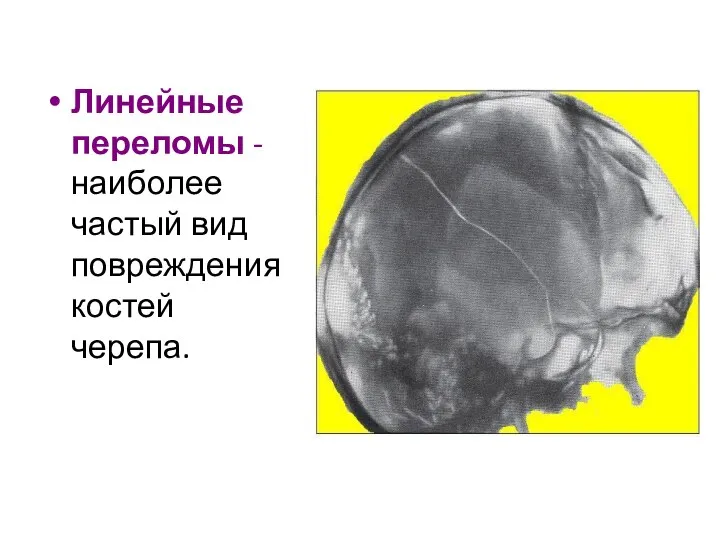 Линейные переломы - наиболее частый вид повреждения костей черепа.