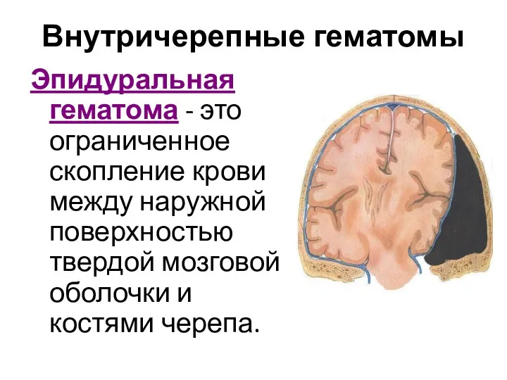 Внутричерепные гематомы Эпидуральная гематома - это ограниченное скопление крови между наружной поверхностью